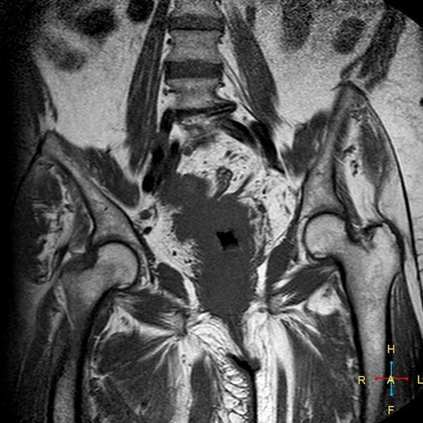 File:Cervical stump squamous cell carcinoma (Radiopaedia 48049-52858 Coronal T1 9).jpg