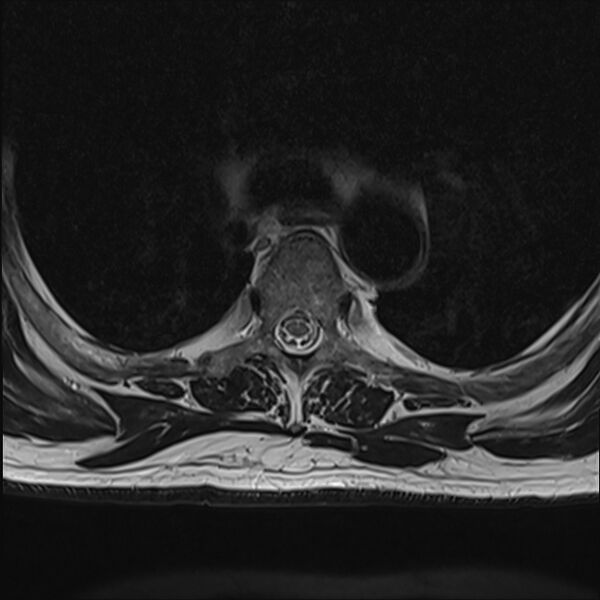 File:Cervical tumor-like myelopathy due to Type V dAVF (Radiopaedia 82461-96604 D 13).jpg