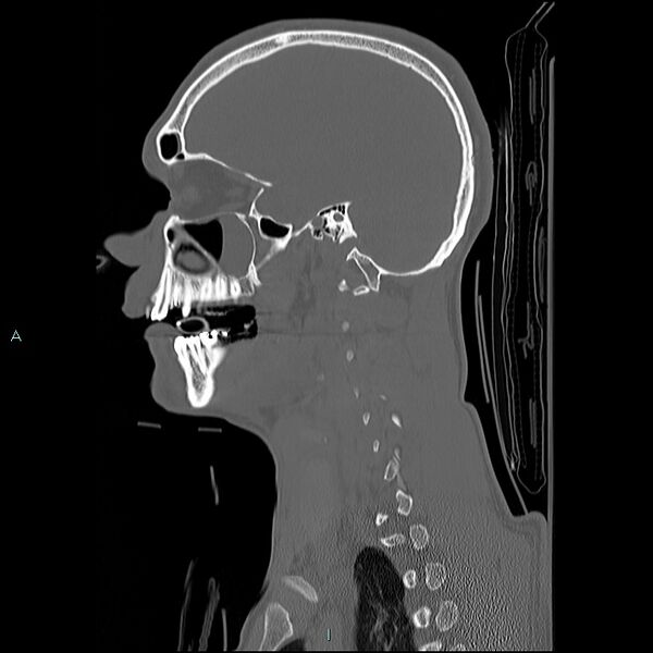 File:Cervical vertebral burst fracture (Radiopaedia 37420-39258 Sagittal bone window 28).jpg