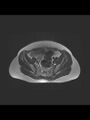 Cesarean section scar endometrioma (Radiopaedia 56569-63297 Axial T2 8).jpg