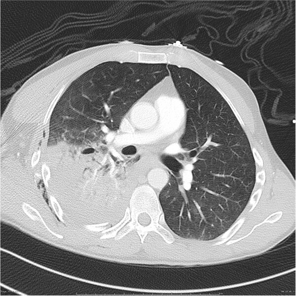 File:Chest and abdomen multi-trauma (Radiopaedia 26294-26425 lung window 52).jpg