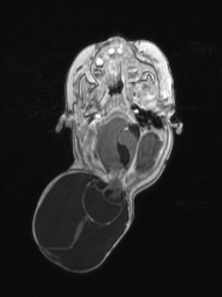 File:Chiari III malformation with occipital encephalocele (Radiopaedia 79446-92559 Axial T1 C+ mpr 34).jpg