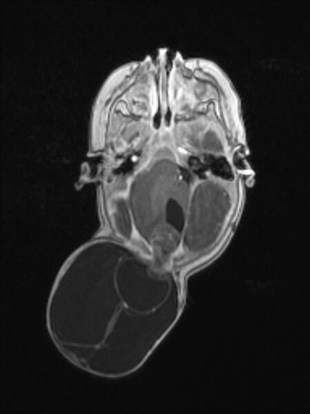 File:Chiari III malformation with occipital encephalocele (Radiopaedia 79446-92559 Axial T1 C+ mpr 36).jpg