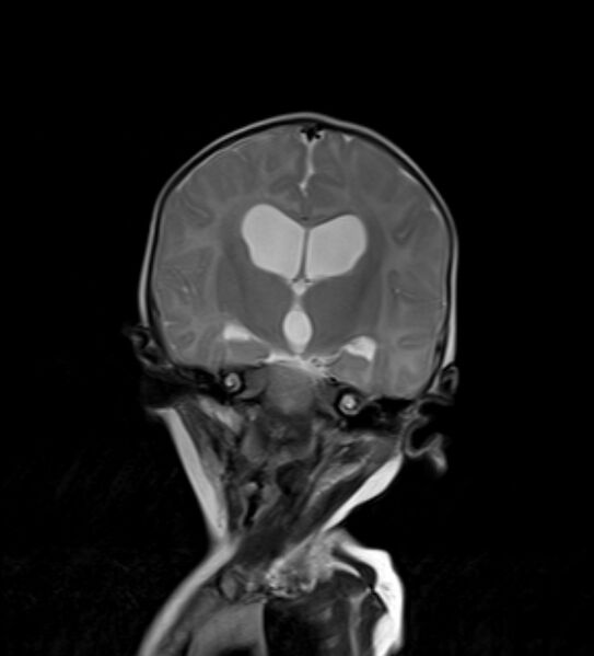 File:Chiari III malformation with occipital encephalocele (Radiopaedia 79446-92559 Coronal T2 22).jpg