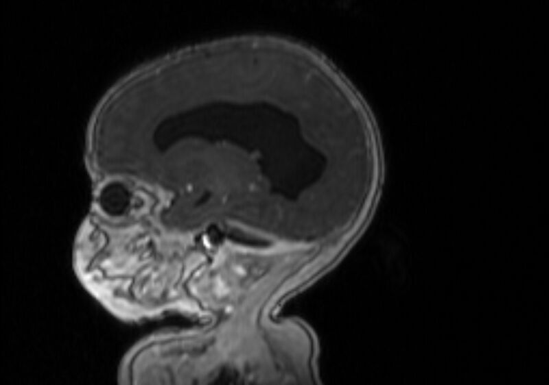 File:Chiari III malformation with occipital encephalocele (Radiopaedia 79446-92559 Sagittal T1 C+ mpr 44).jpg