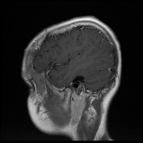 File:Chiasmatic-hypothalamic juvenile pilocytic astrocytoma (Radiopaedia 78533-91236 Sagittal T1 C+ 5).jpg