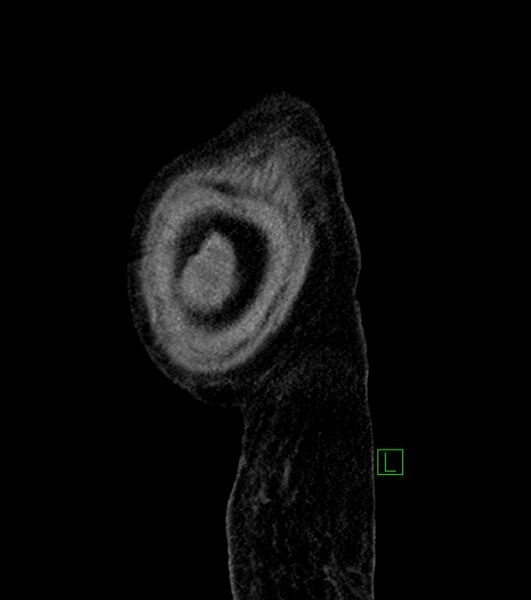 File:Cholangiocarcinoma with cerebral metastases (Radiopaedia 83519-98629 F 8).jpg