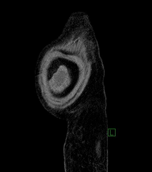 File:Cholangiocarcinoma with cerebral metastases (Radiopaedia 83519-98629 F 9).jpg