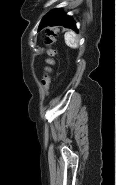 File:Cholecystoduodenal fistula due to calculous cholecystitis with gallstone migration (Radiopaedia 86875-103077 C 6).jpg