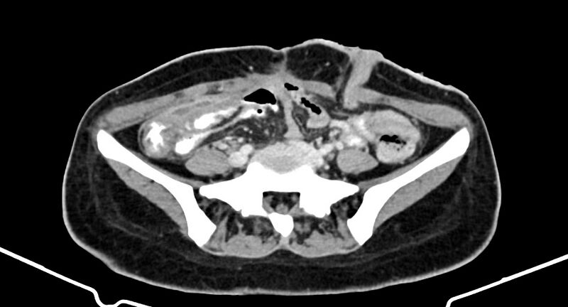 File:Choriocarcinoma liver metastases (Radiopaedia 74768-85766 A 144).jpg