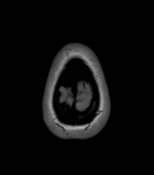 File:Choroid plexus carcinoma (Radiopaedia 91013-108553 Axial T1 157).jpg