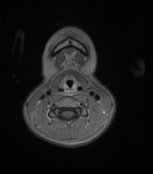 File:Choroid plexus carcinoma (Radiopaedia 91013-108553 Axial T1 C+ 12).jpg