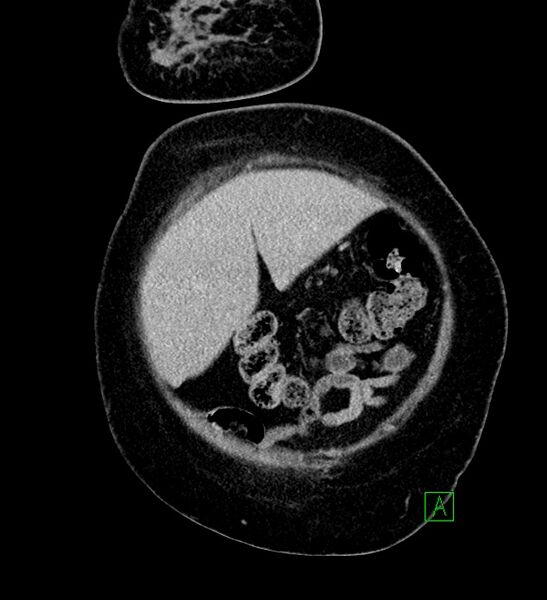 File:Chromophobe renal cell carcinoma (Radiopaedia 84239-99519 F 14).jpg