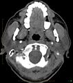 Chronic Submandibular sialolithiasis (Radiopaedia 16880-16606 Axial non-contrast 3).jpg
