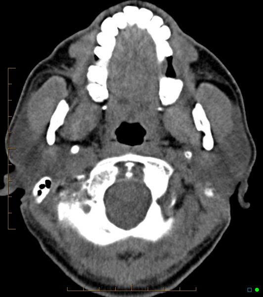File:Chronic Submandibular sialolithiasis (Radiopaedia 16880-16606 Axial non-contrast 3).jpg