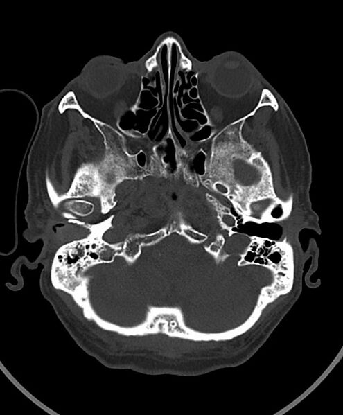 File:Chronic bilateral subdural hygroma (Radiopaedia 85801-101623 Axial bone window 99).jpg