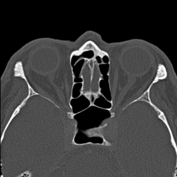 File:Chronic maxillary sinusitis (Radiopaedia 27879-28116 Axial bone window 37).jpg