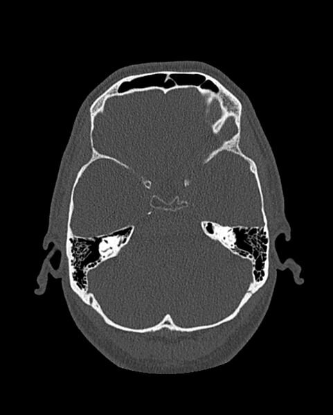 File:Chronic maxillary sinusitis caused by a foreign body (Radiopaedia 58521-65676 Axial bone window 268).jpg