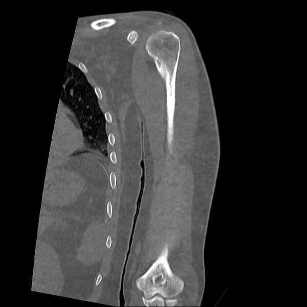 File:Chronic osteomyelitis (Radiopaedia 67597-76998 Coronal bone window 5).jpg