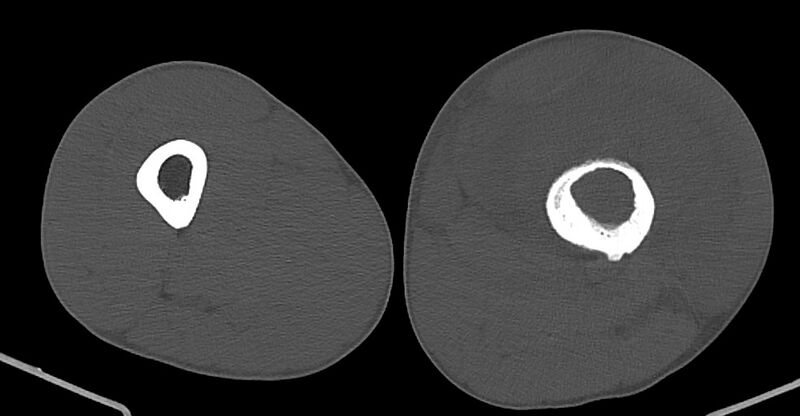 File:Chronic osteomyelitis (with sequestrum) (Radiopaedia 74813-85822 Axial non-contrast 101).jpg