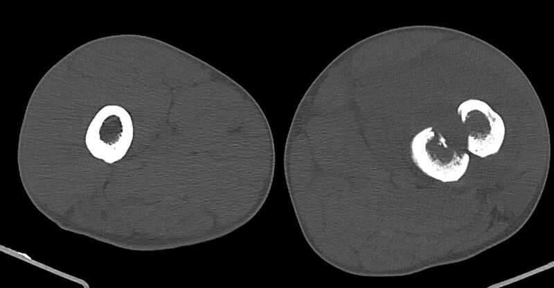File:Chronic osteomyelitis (with sequestrum) (Radiopaedia 74813-85822 Axial non-contrast 83).jpg