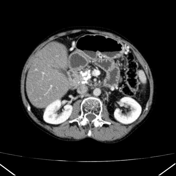 File:Chronic pancreatitis (Radiopaedia 23132-23172 B 24).jpg