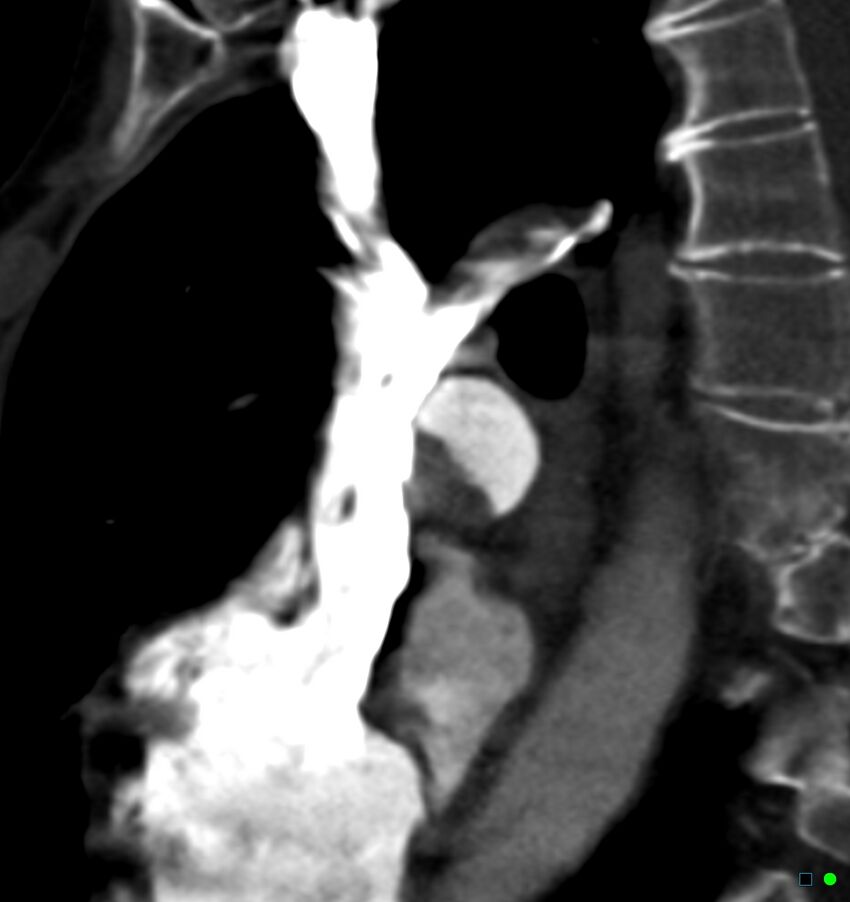 Chronic pulmonary embolism (Radiopaedia 17943-17702 Sagittal C+ CTPA 20).jpg