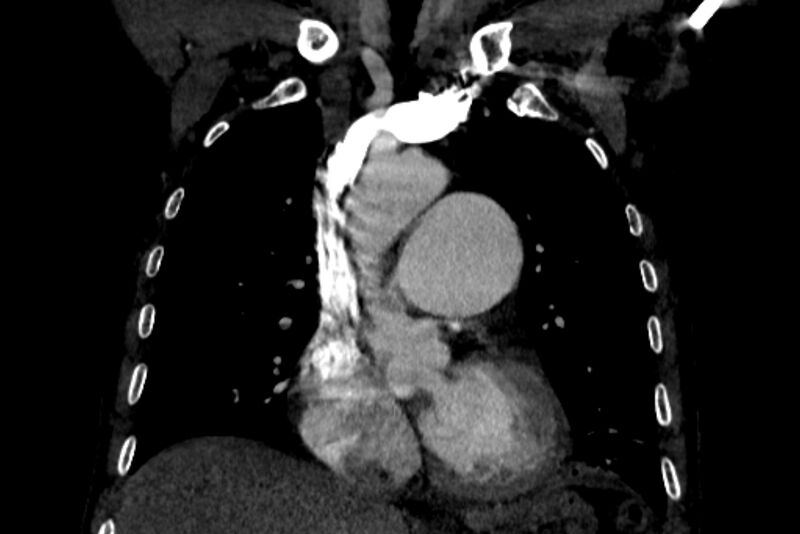 File:Chronic pulmonary embolism with bubbly consolidation (Radiopaedia 91248-108850 B 57).jpg