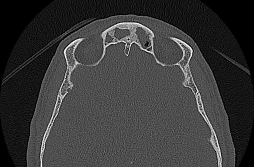 Chronic rhinosinusitis (Radiopaedia 65079-74075 Axial bone window 71).jpg