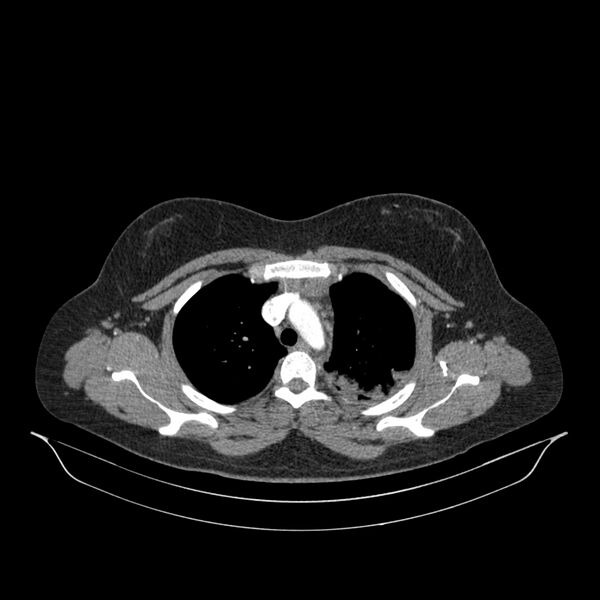 File:Chronic thromboembolic pulmonary hypertension (CTEPH) (Radiopaedia 74597-85532 Axial C+ CTPA 121).jpg