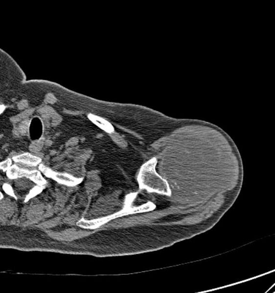 File:Clear cell chondrosarcoma - humerus (Radiopaedia 63104-71612 Axial non-contrast 24).jpg