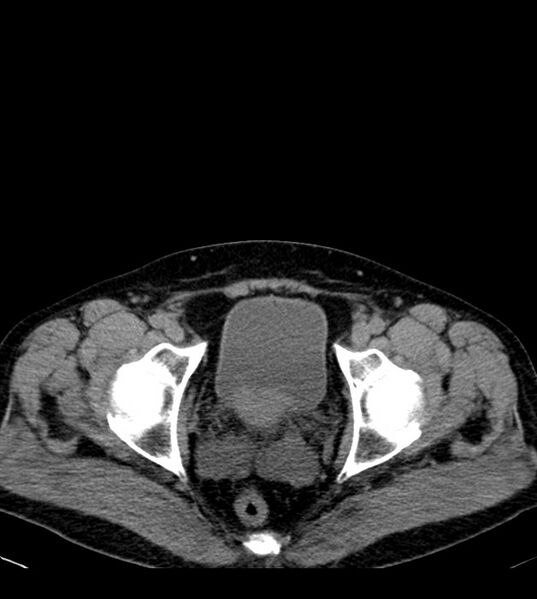 File:Clear cell renal cell carcinoma (Radiopaedia 85006-100539 Axial non-contrast 82).jpg