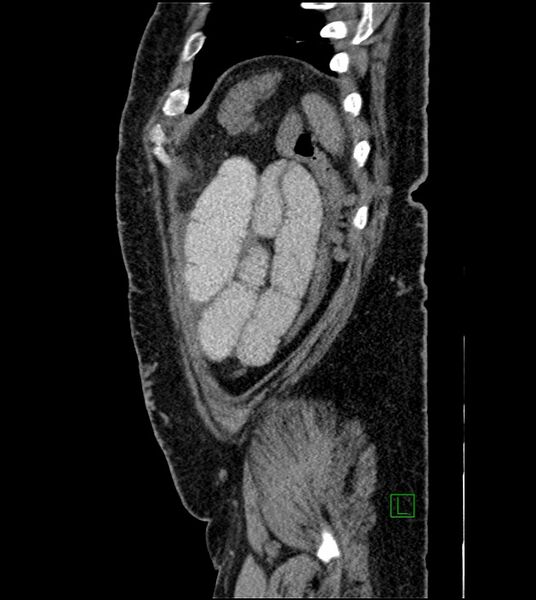 File:Closed-loop small bowel obstruction-internal hernia (Radiopaedia 78439-91096 C 27).jpg