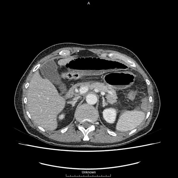 File:Closed loop bowel obstruction and ischemia (Radiopaedia 86959-103180 A 16).jpg