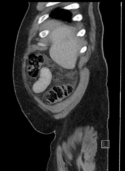 File:Closed loop obstruction - internal hernia into nephrectomy bed (Radiopaedia 59867-67320 C 100).jpg