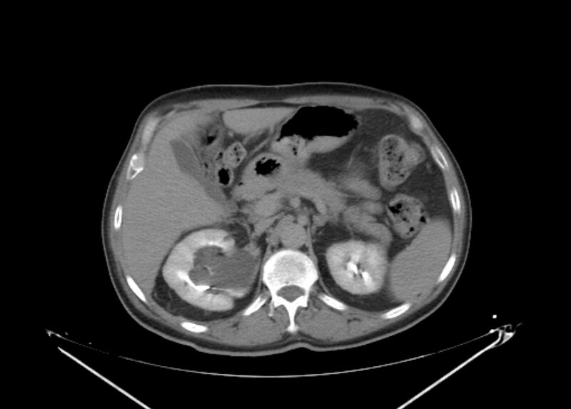 File:Colon cancer mimicking renal cell carcinoma (Radiopaedia 28986-29335 Axial C+ delayed 22).jpg