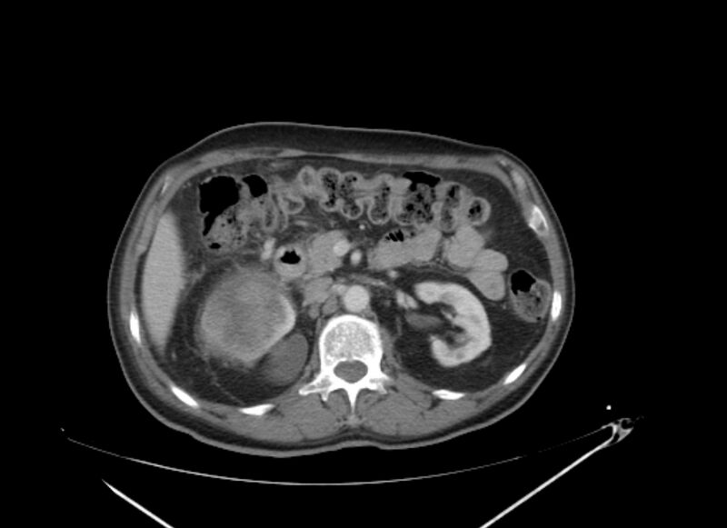 File:Colon cancer mimicking renal cell carcinoma (Radiopaedia 28986-29335 C 28).jpg
