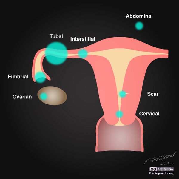 File:Ectopic pregnancy distribution (diagram) (Radiopaedia 35931).jpg