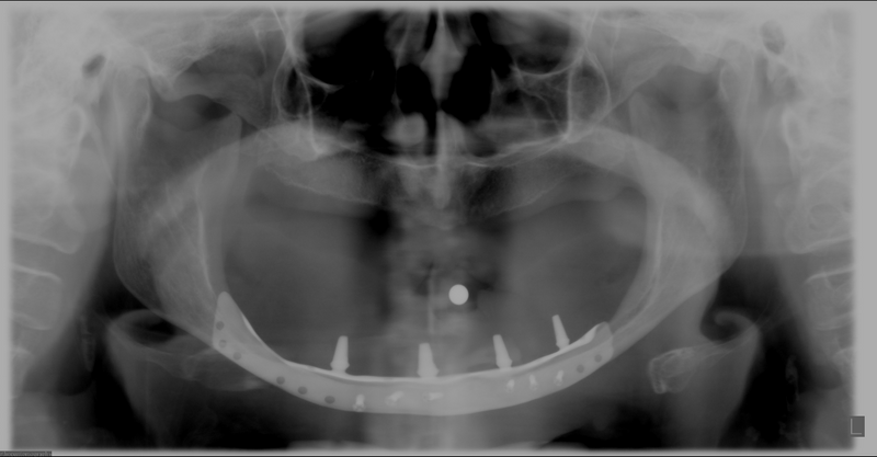 File:Jaw implant (Radiopaedia 85145).PNG
