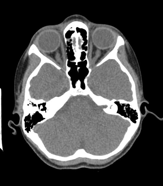 File:Nasoorbitoethmoid fracture (Radiopaedia 90044-107205 Axial non-contrast 163).jpg