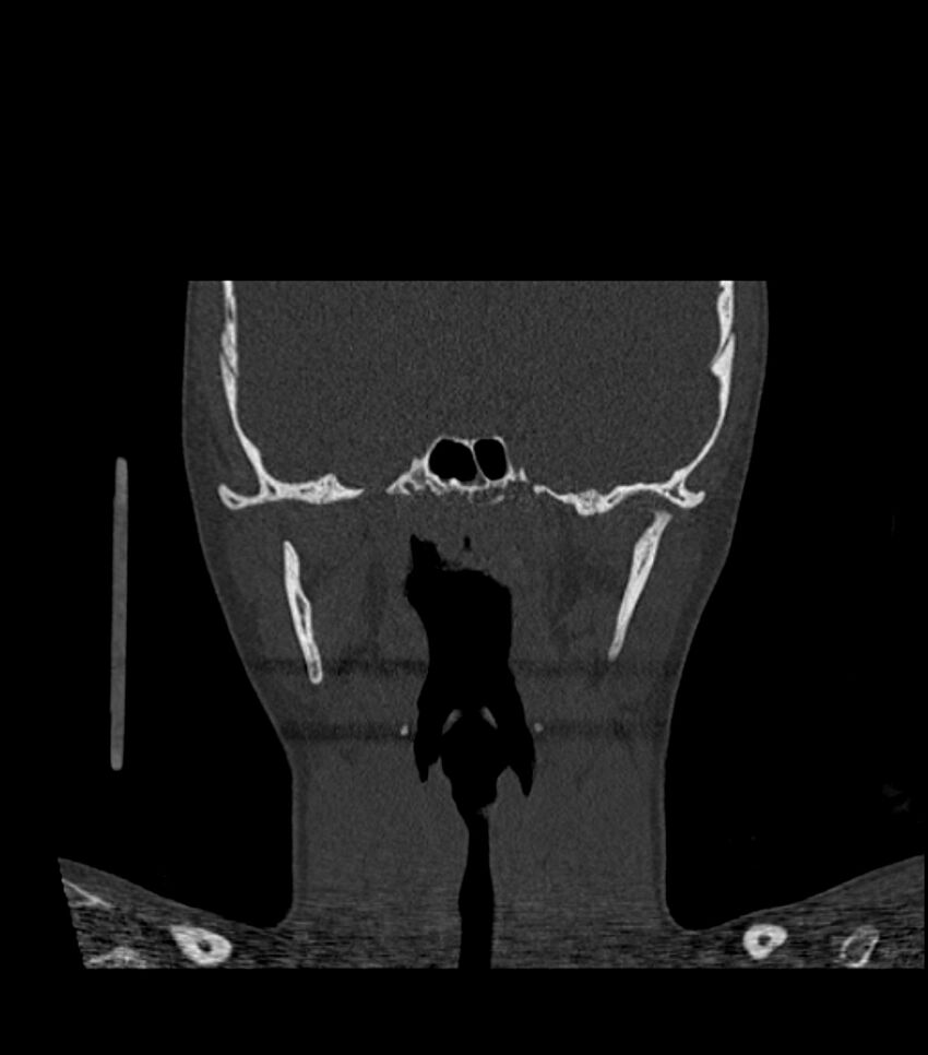 Nasoorbitoethmoid fracture (Radiopaedia 90044-107205 Coronal bone window 85).jpg
