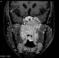 Nasopharyngeal carcinoma (Radiopaedia 4546-6667 E 6).jpg