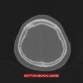 Nasopharyngeal carcinoma recurrence - skull base destruction (Radiopaedia 29107-29490 Axial bone window 18).jpg