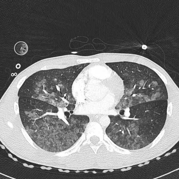 File:Near drowning (pulmonary edema) (Radiopaedia 24685-24958 lung window 35).jpg