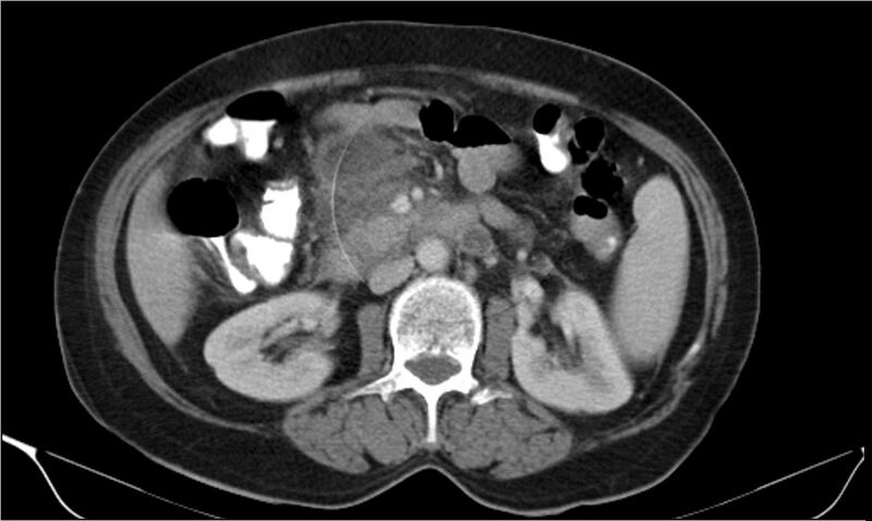 File:Necrotizing pancreatitis (Radiopaedia 20595-20495 A 18).jpg