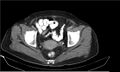 Necrotizing pancreatitis (Radiopaedia 20595-20495 Axial C+ delayed 42).jpg