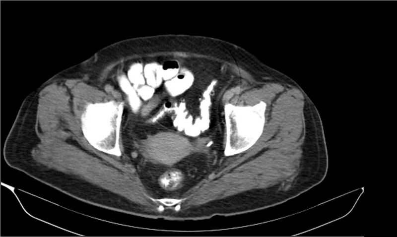 File:Necrotizing pancreatitis (Radiopaedia 20595-20495 Axial C+ delayed 42).jpg