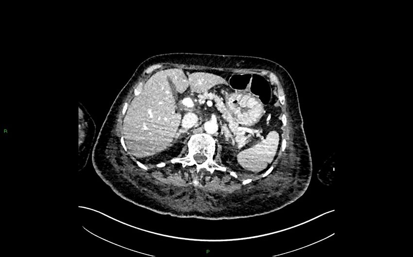 Neo-terminal ileal stricture (Crohn disease) (Radiopaedia 33790-34948 A 119).jpg