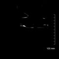 Neonatal neuroblastoma (Radiopaedia 56651-63438 Coronal non-contrast 54).jpg