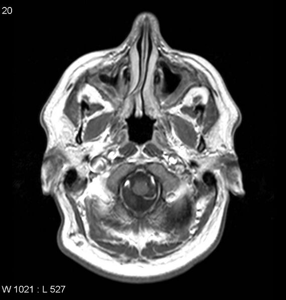 File:Neurosarcoidosis (Radiopaedia 10930-11351 Axial T1 C+ 1).jpg